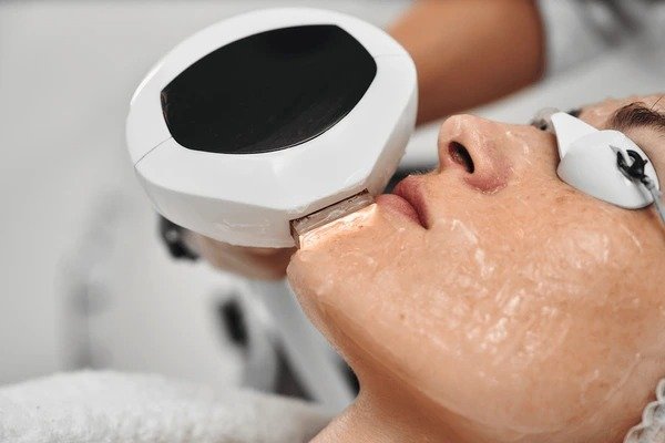 tratamiento facial ipl acne